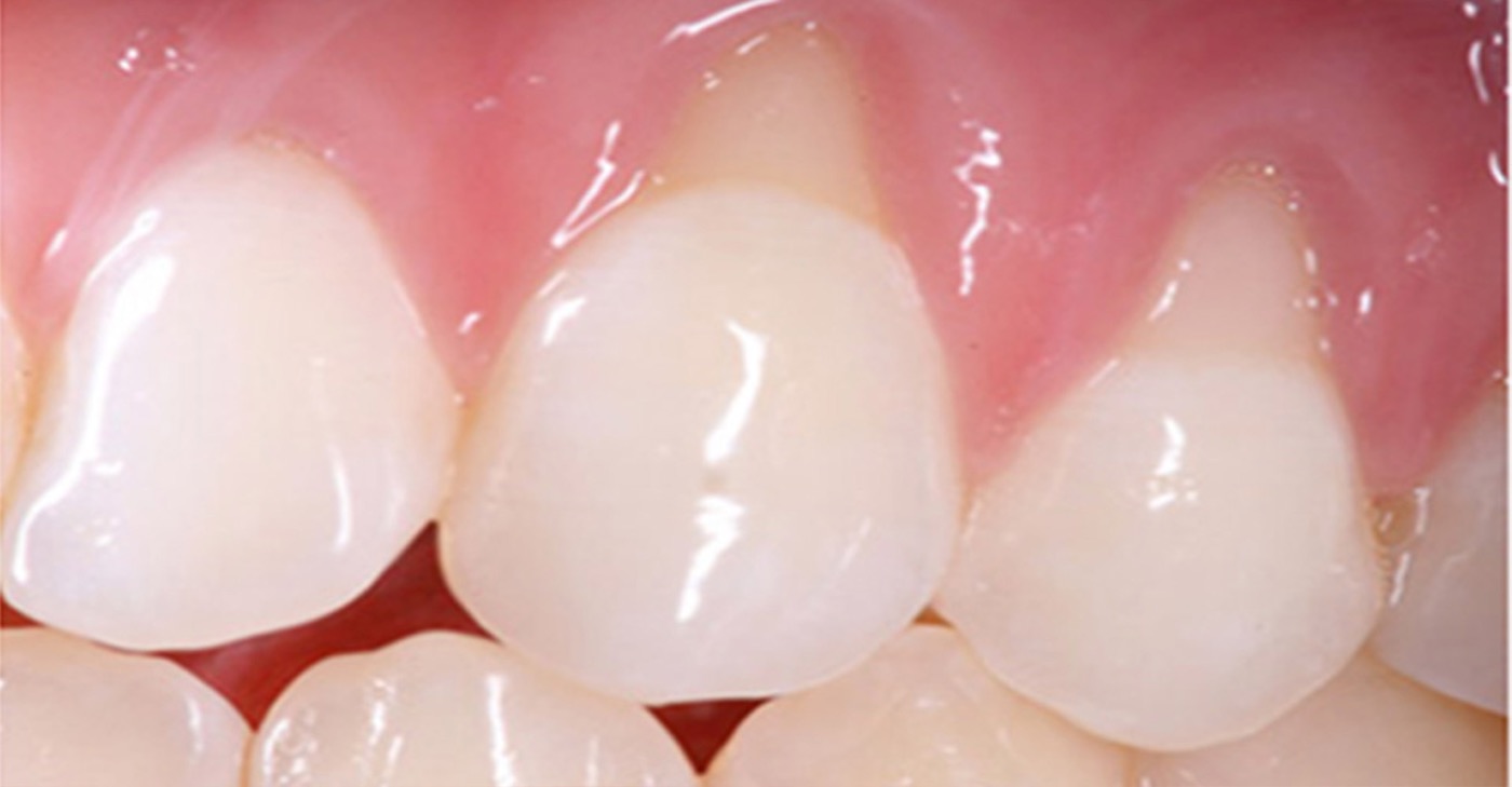 Soins des gencives