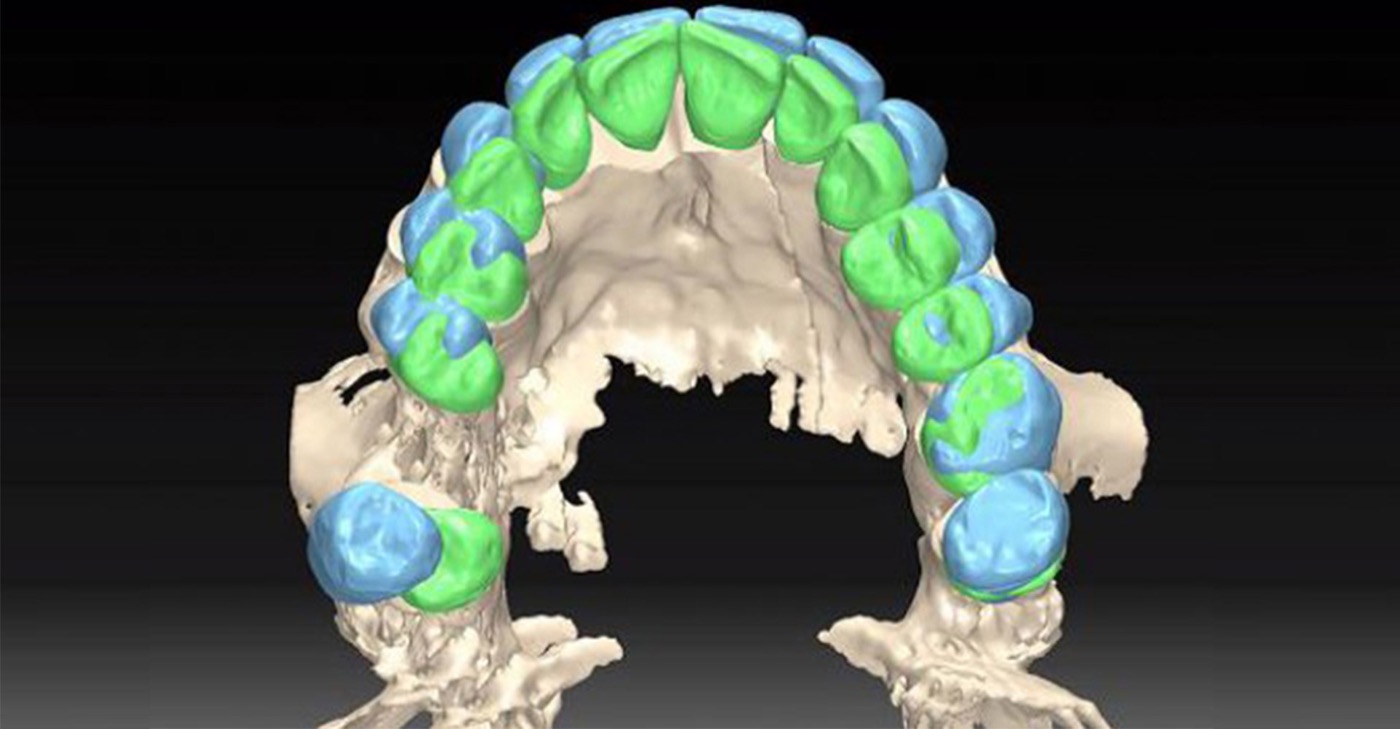 Réhabilitation complète sur implants
